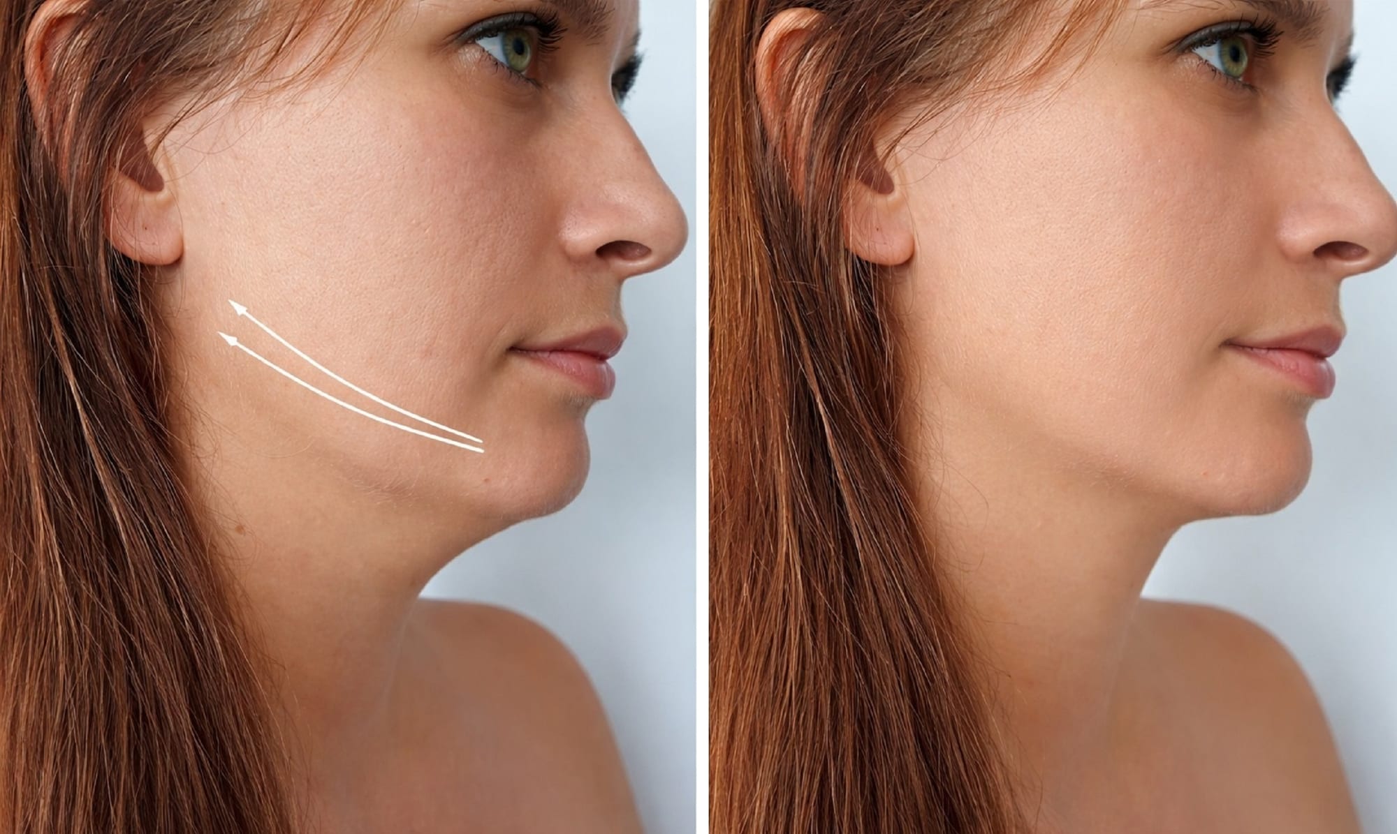 Lifting de cuello caso 6 — antes y después
